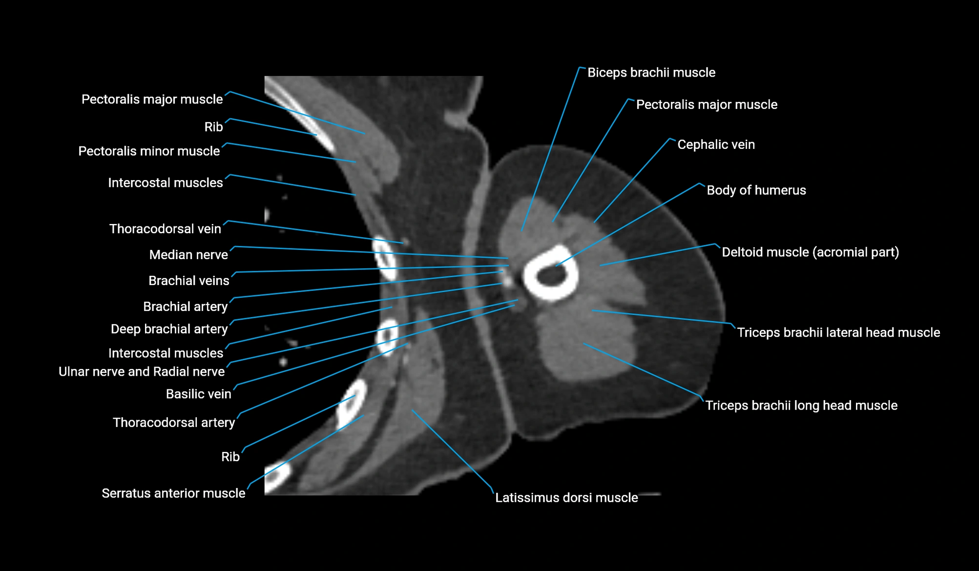 CT upper arm axial  cross sectional anatomy labelled radiology image -00184.webp